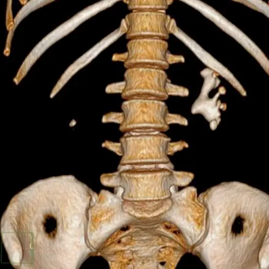 3D CT Dorso-Lumbar Spine